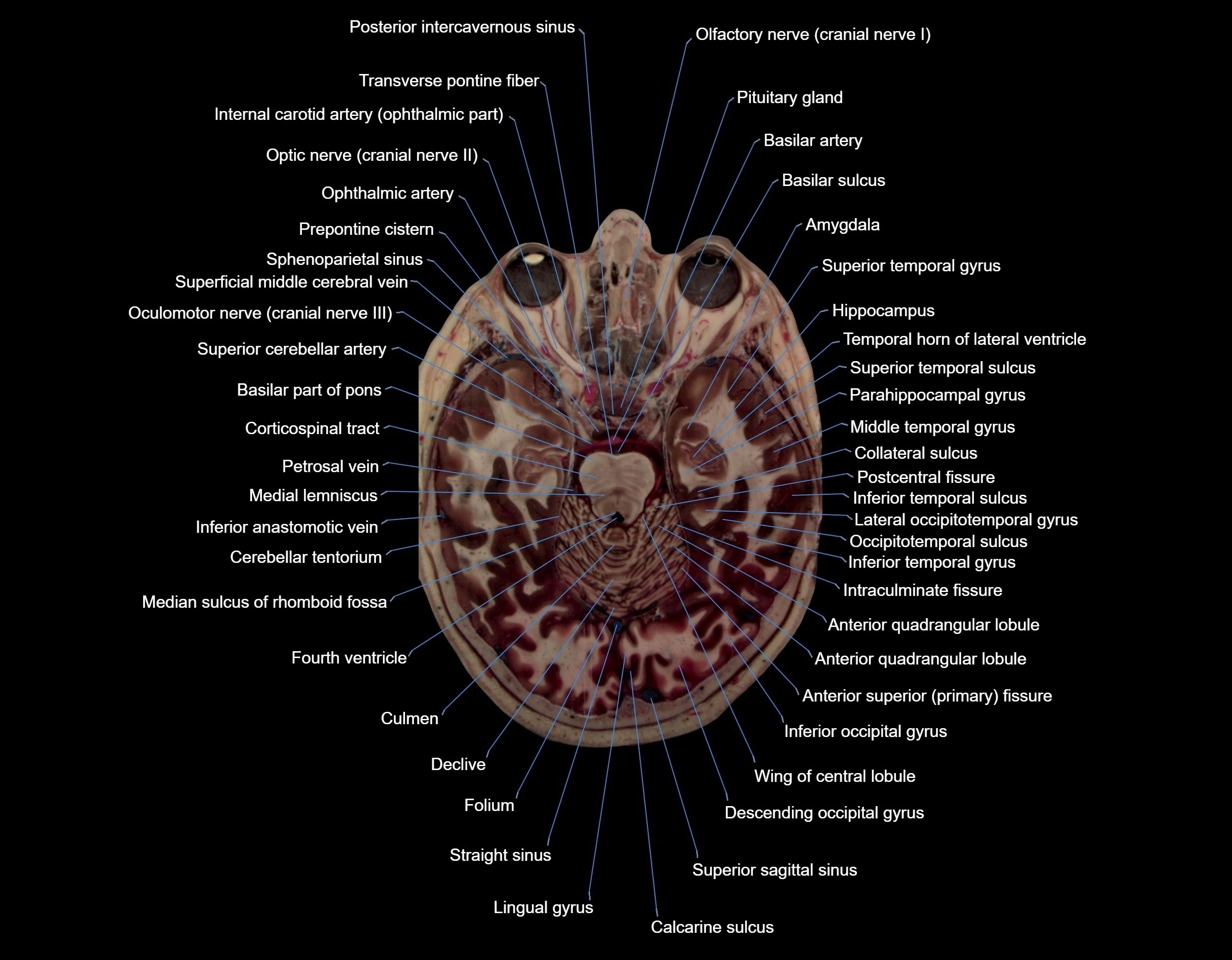 MRI Brain axial cross sectional radiology anatomy 3T image  -img-000031.webp